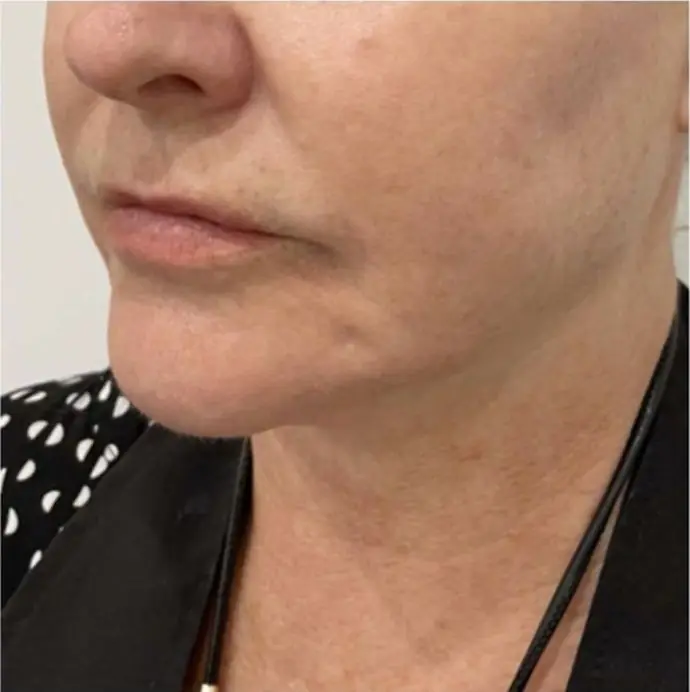 Firmer, more defined jawline after treatment