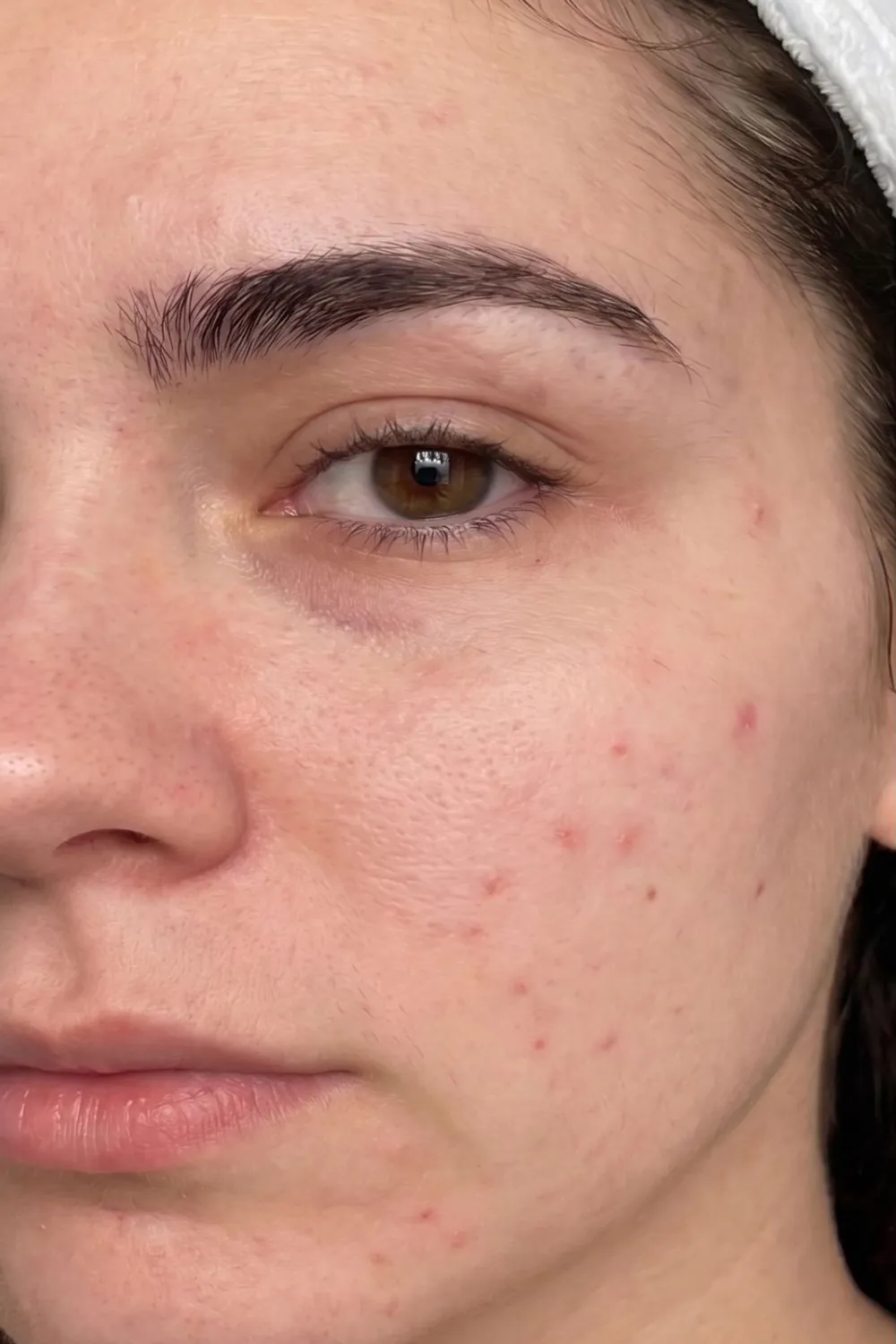 Acne and congestion before treatment