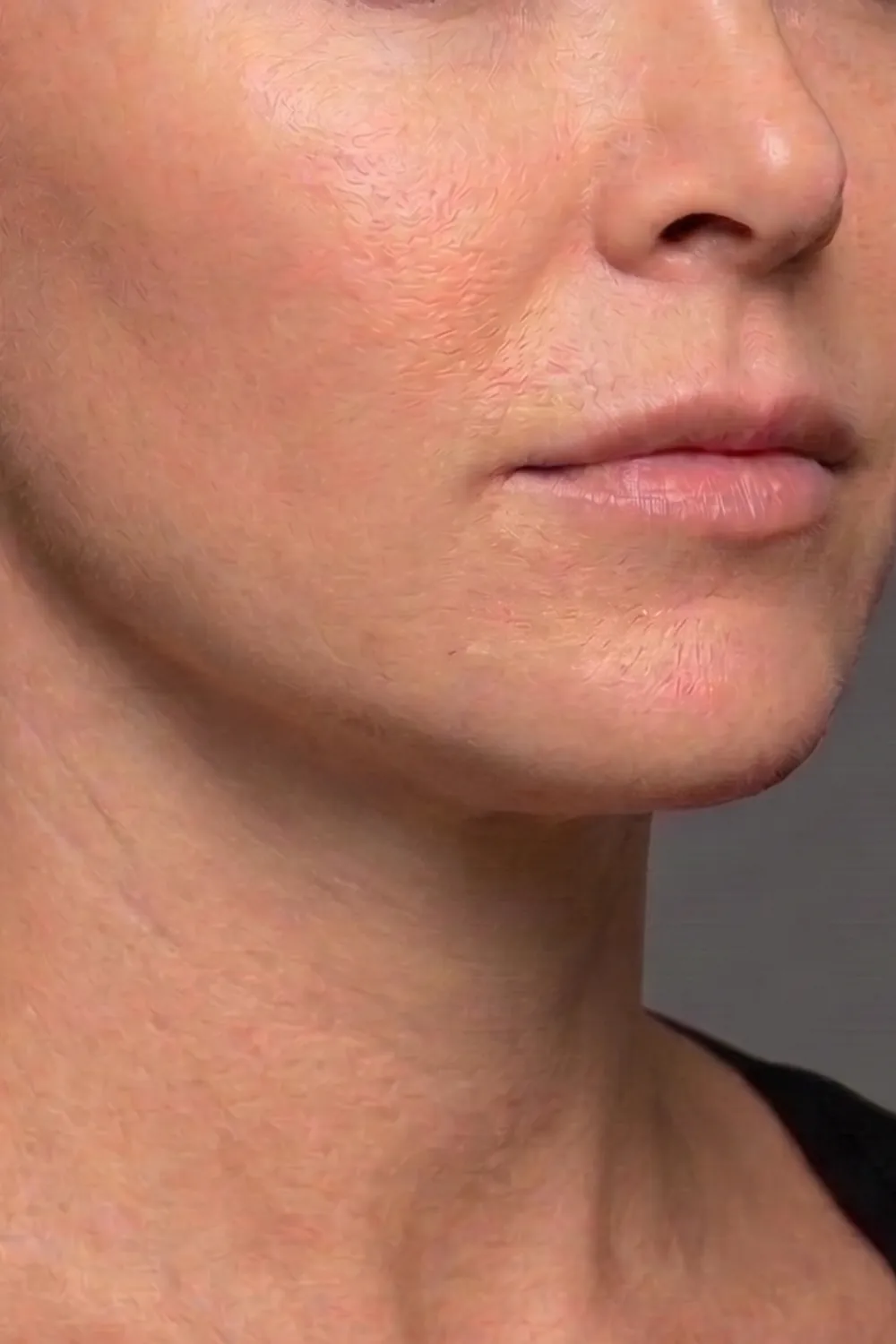 The same client's jawline after treatment