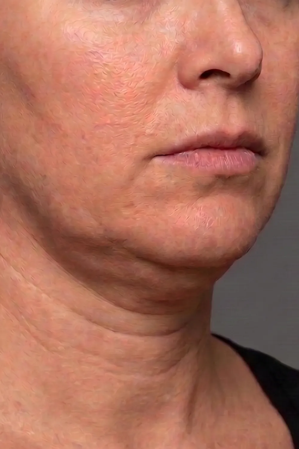 Jawline before treatment