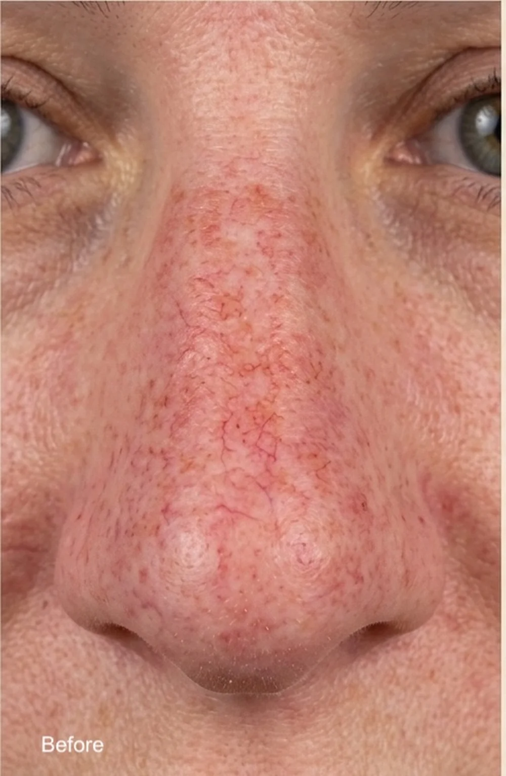 Visible facial vessels and redness before treatment
