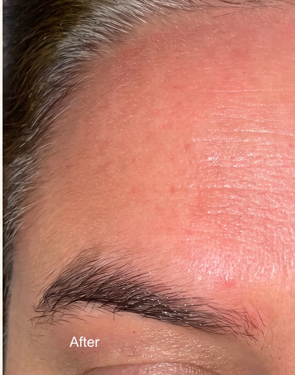 Pigmentation before and after treatment, after