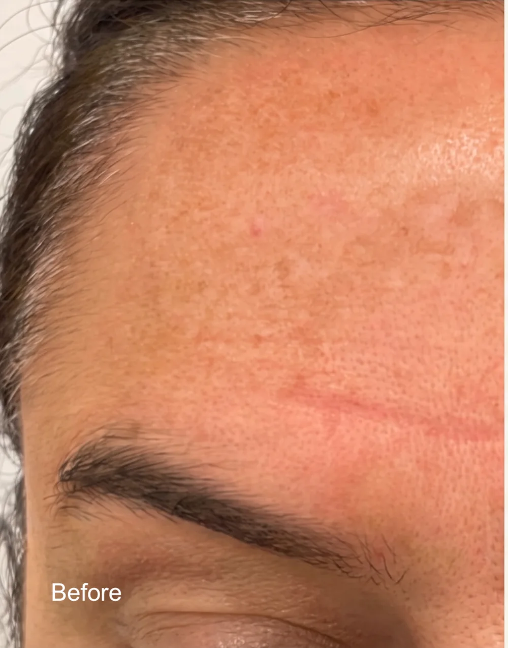 Pigmentation before and after treatment, before