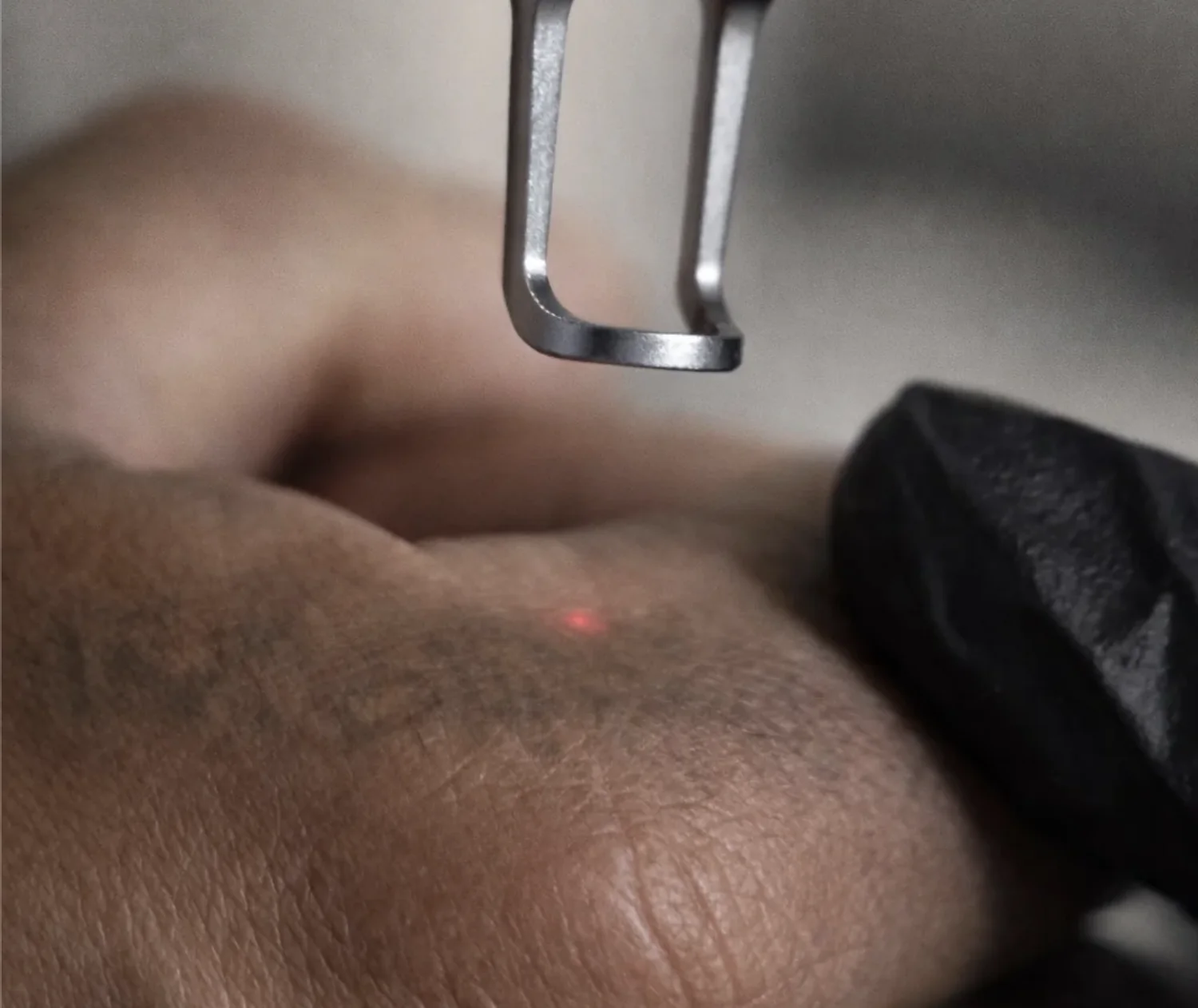 Pico laser handpiece positioned over a client's skin during treatment