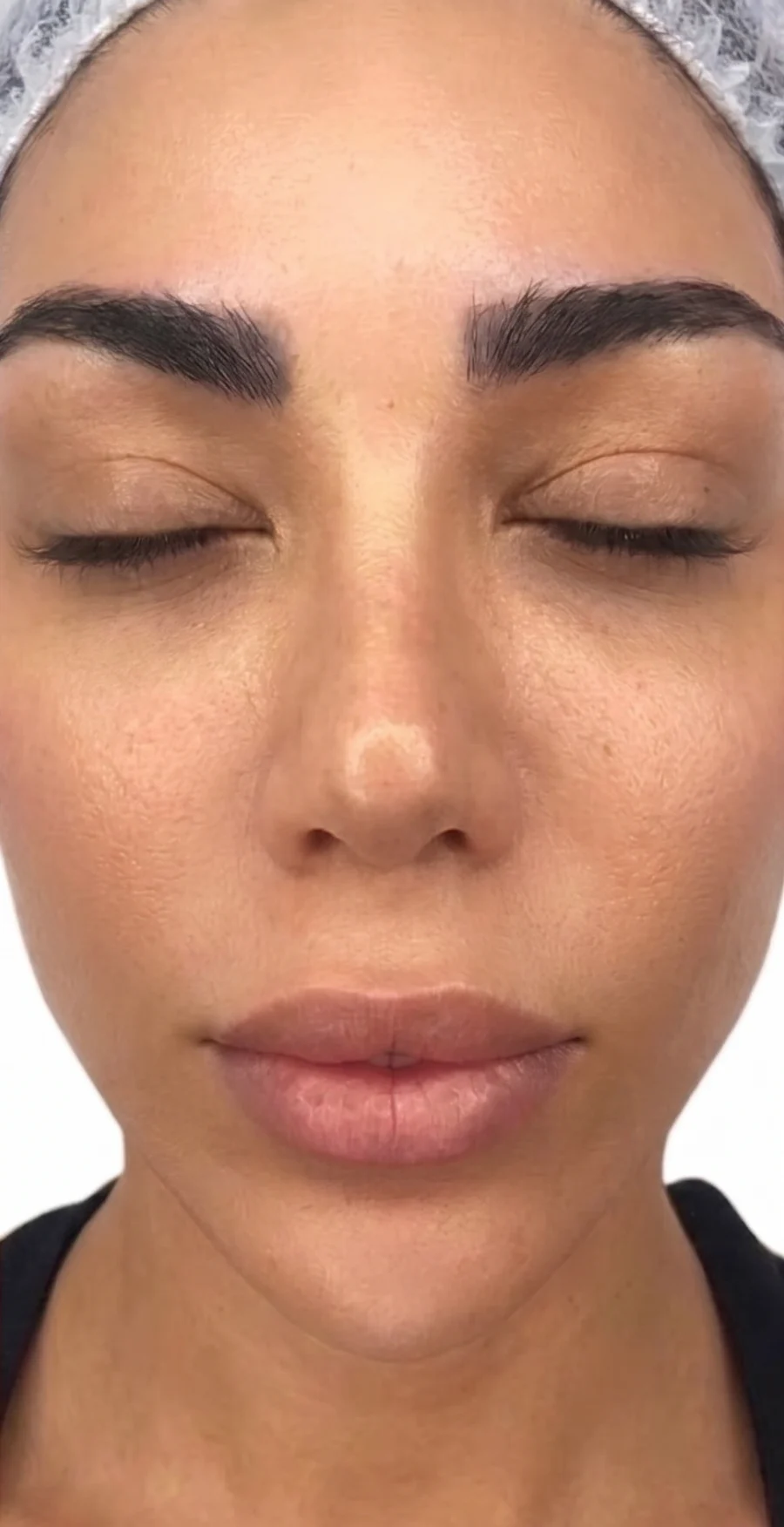 Sun damage after BBL, peels and resurfacing