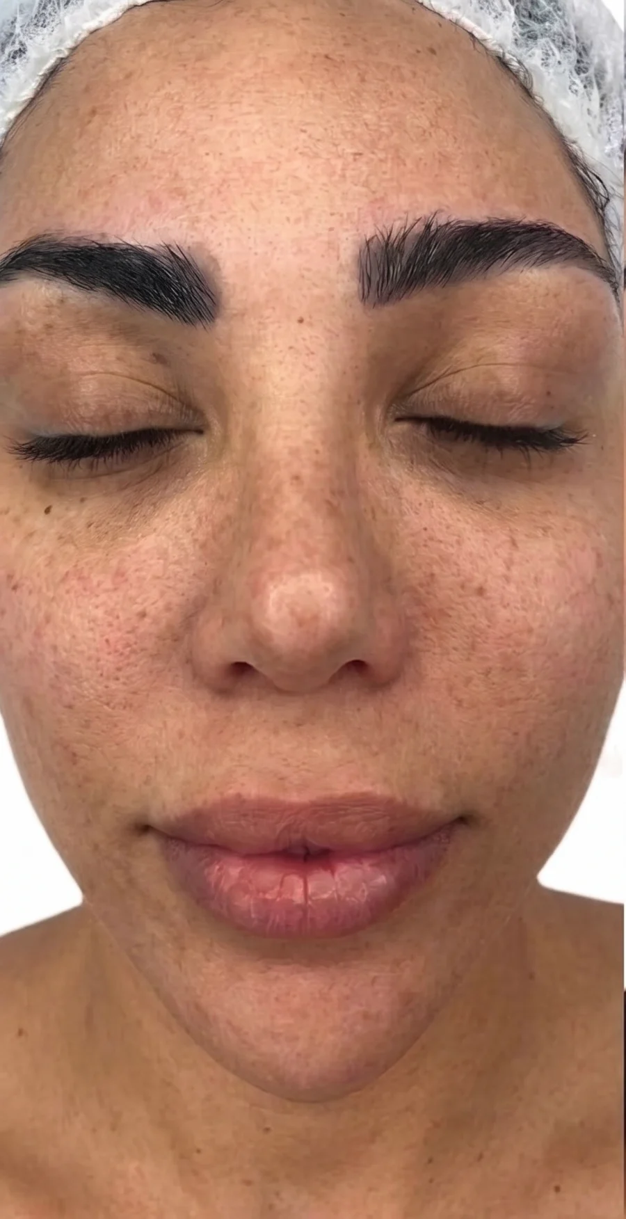 Sun damage before BBL, peels and resurfacing